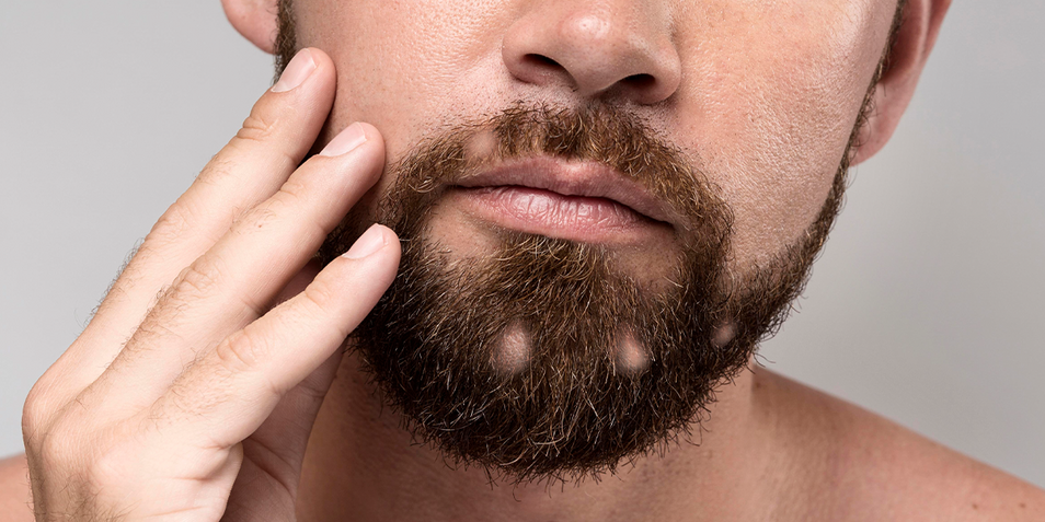 A man with a patchy beard